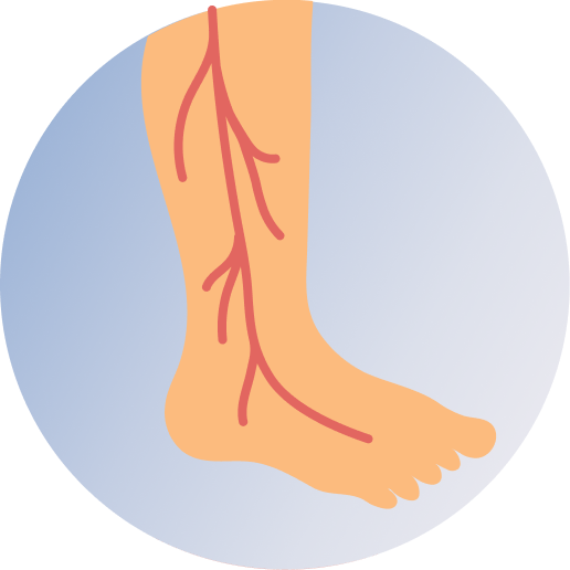 Varicose Veins